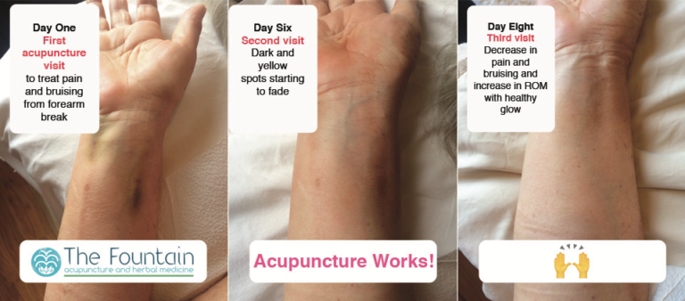 Decrease of bruising of broken forearm after two treatments
