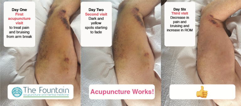 Decreased arm bruising from break after two treatments
