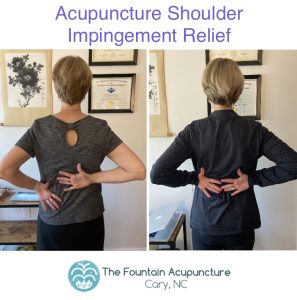 Woman's shoulder improving drastically though acupuncture treatment